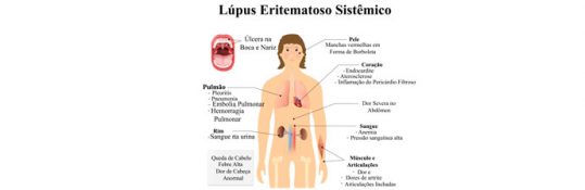 Tratamento Fisioterapêutico do Lúpus Eritematoso Sistêmico