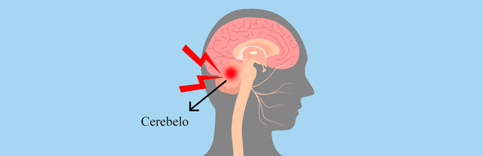 Ataxia: Lesão no Cerebelo