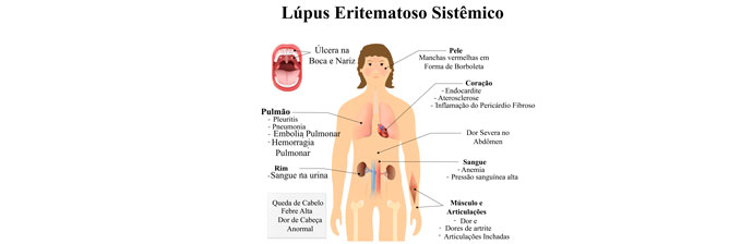 Lupus Eritematoso Sistêmico