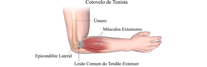 tratamentul articulației post traumatice a articulației genunchiului inflamația tendoanelor articulațiilor cotului simptomelor