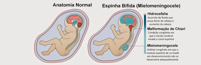 mielomeningocele