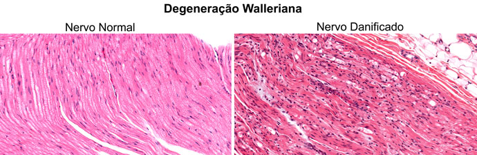 Lesões dos Nervos Periféricos: Degeneração Walleriana