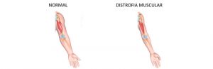 Distrofia Miotônica de Steinert: Tudo que Você Precisa Saber