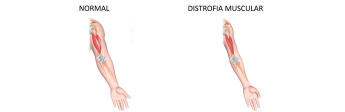 Distrofia Miotônica de Steinert: Tudo que Você Precisa Saber