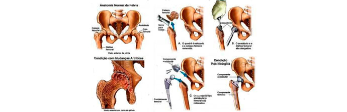 artroplastia-7