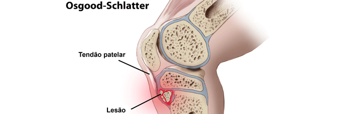 osgood-schlatter-1