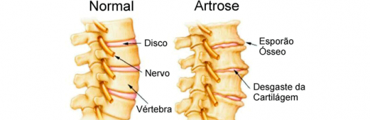 Saiba como Reabilitar as Principais Patologias da Coluna Vertebral