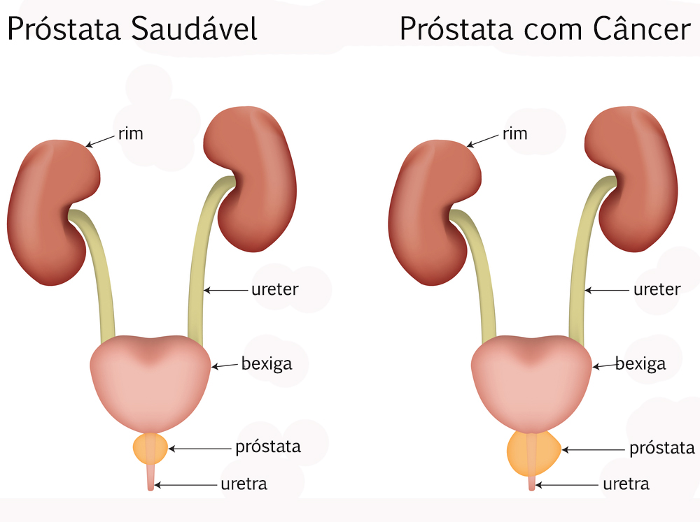 cancer malign prostata)