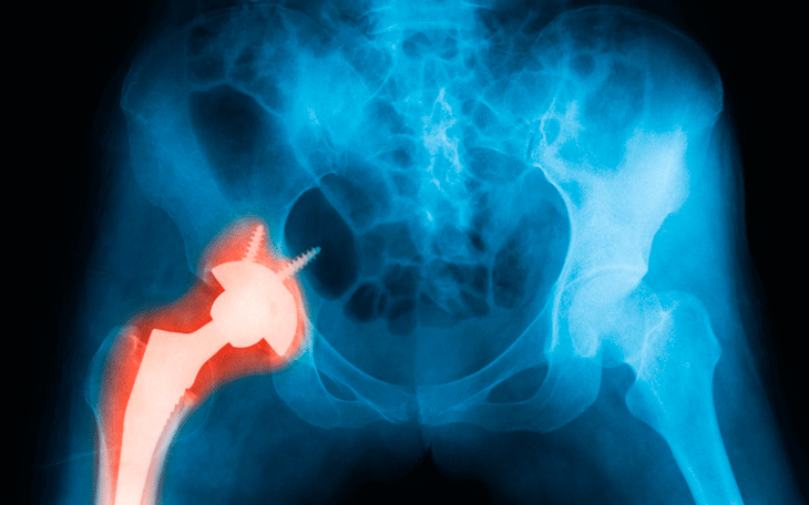 O que é Osteonecrose de quadril e como tratar com a fisioterapia