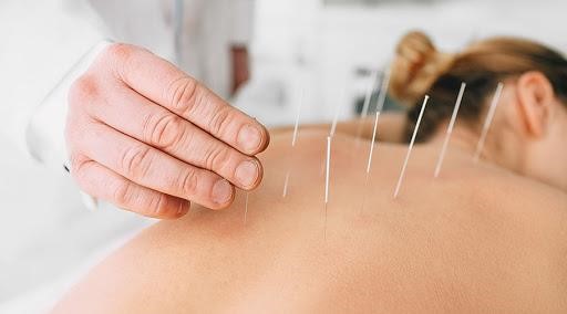acupuntura-para-tensão-nas-costas