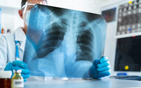 Doença Pulmonar Obstrutiva Crônica e a Atuação Fisioterapêutica