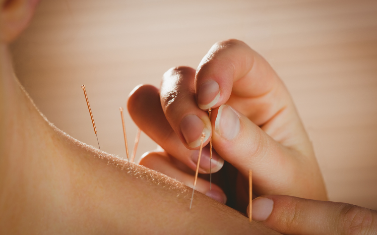 Descubra os benefícios da acupuntura: uma abordagem natural para saúde e bem-estar