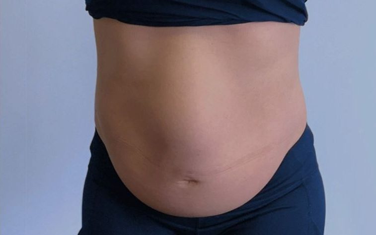 diástase-abdominal-formação-do-cone