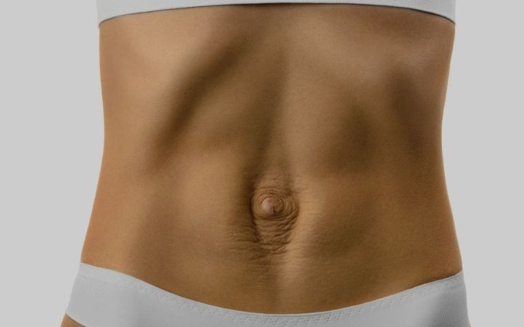 hérnias-umbilicais-ou-abdominais